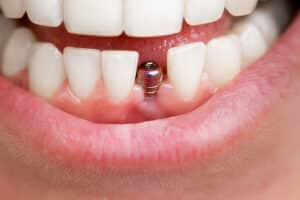 braces and dental implants coexist