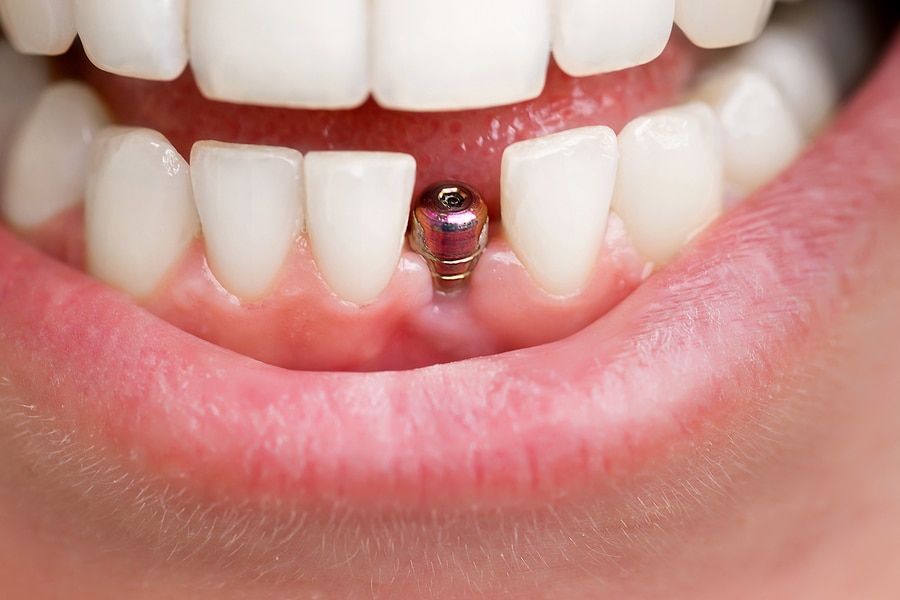 The Science Behind Dental Implants: A Revolutionary Solution