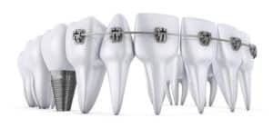 braces and dental implants coexist