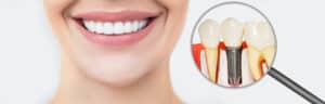 10 Reasons for Dental Implants: A Game-Changer for Oral Health