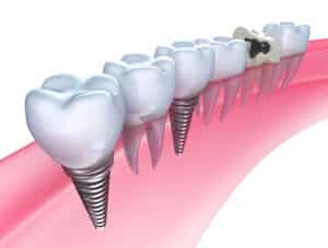 10 Reasons for Dental Implants: A Game-Changer for Oral Health