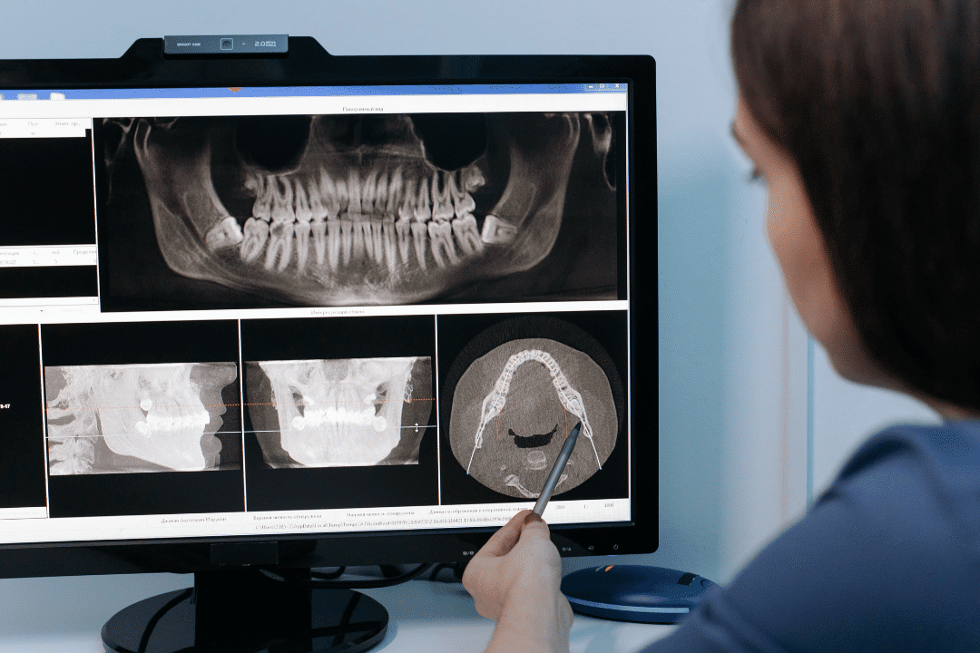 closeup of dental implant placement