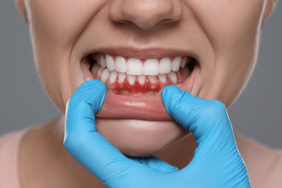 red swollen gums rockville