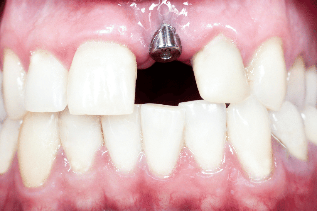 x-ray of dental implants