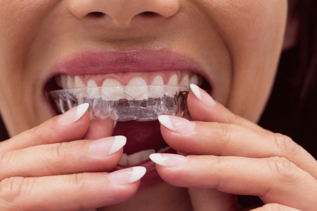 invisalign before and after rockville