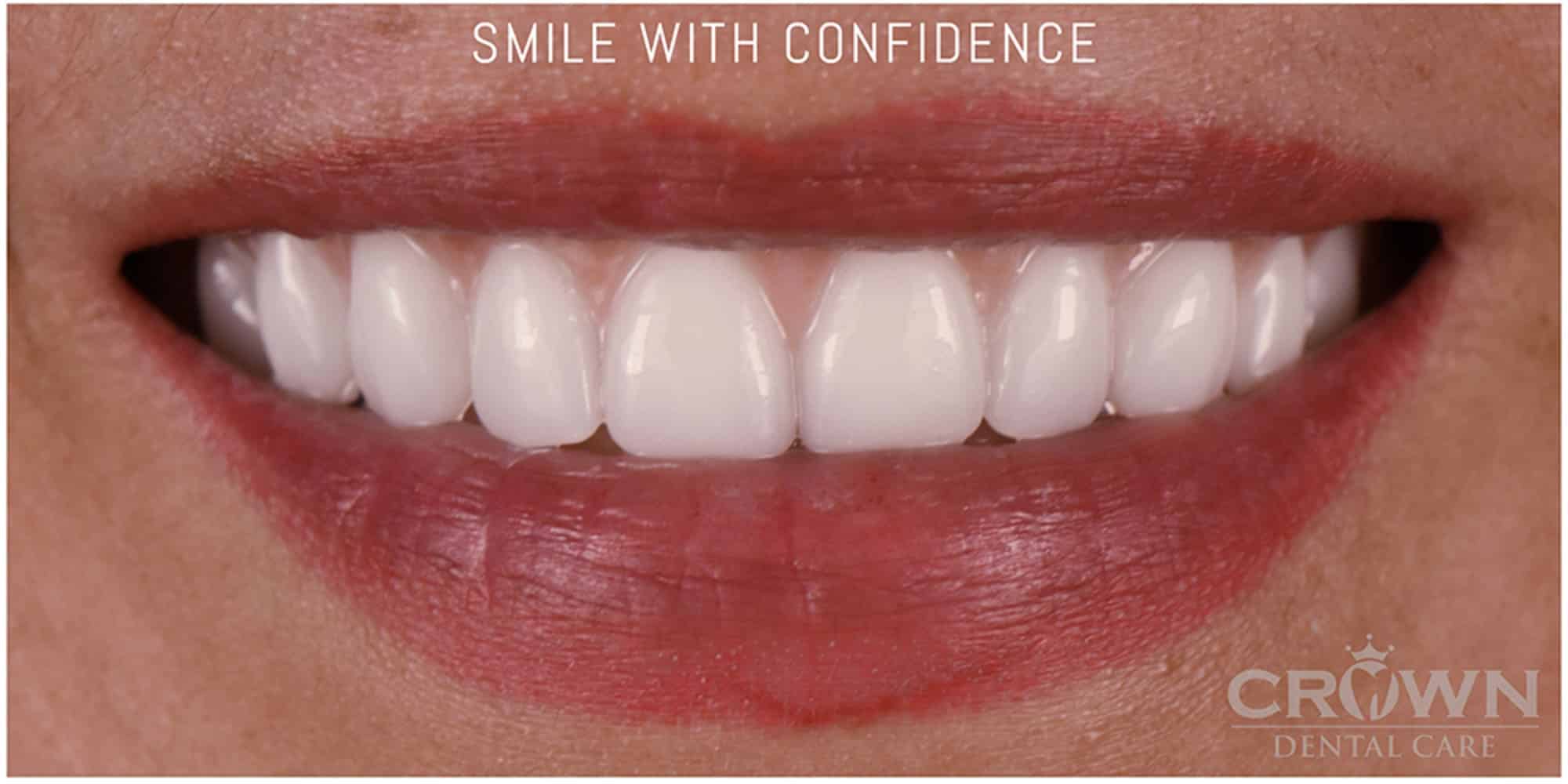 Patient after dental implant treatment — restored smile by Crown Dental Care, Rockville MD