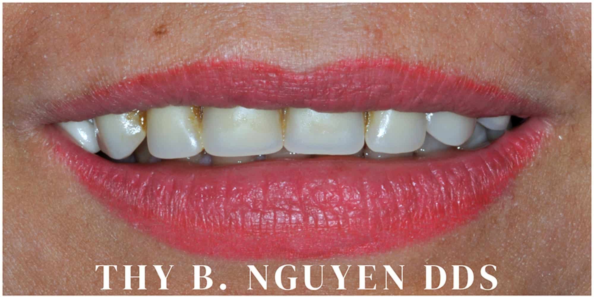 Patient before dental implant treatment at Crown Dental Care in Rockville, MD