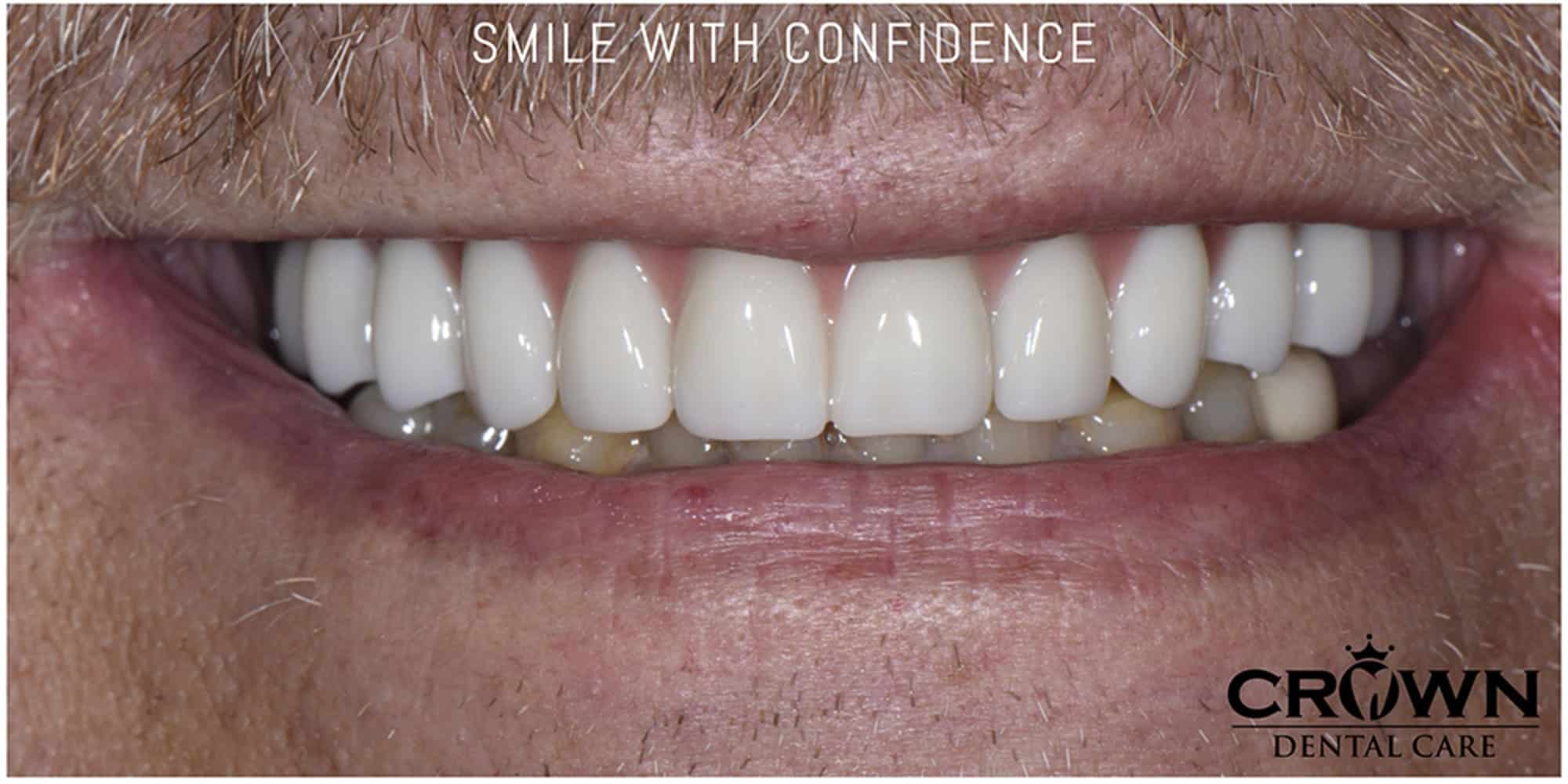 Same patient after full-arch dental implant restoration at Crown Dental Care