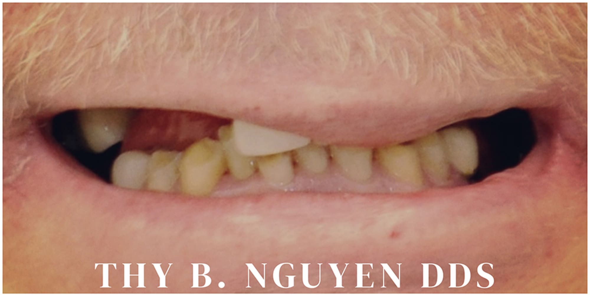 Patient with missing teeth before dental implants in Rockville, MD
