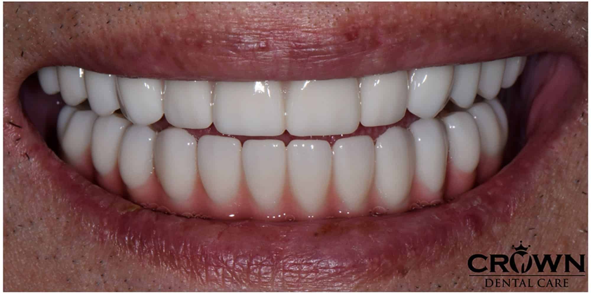 Same patient after single-tooth dental implant by Dr. Thy Nguyen, Crown Dental Care