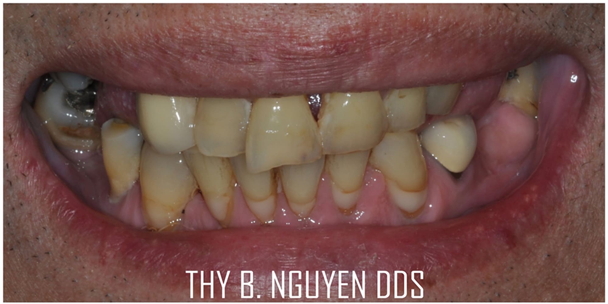 Damaged front teeth before single-tooth implant treatment, Rockville MD