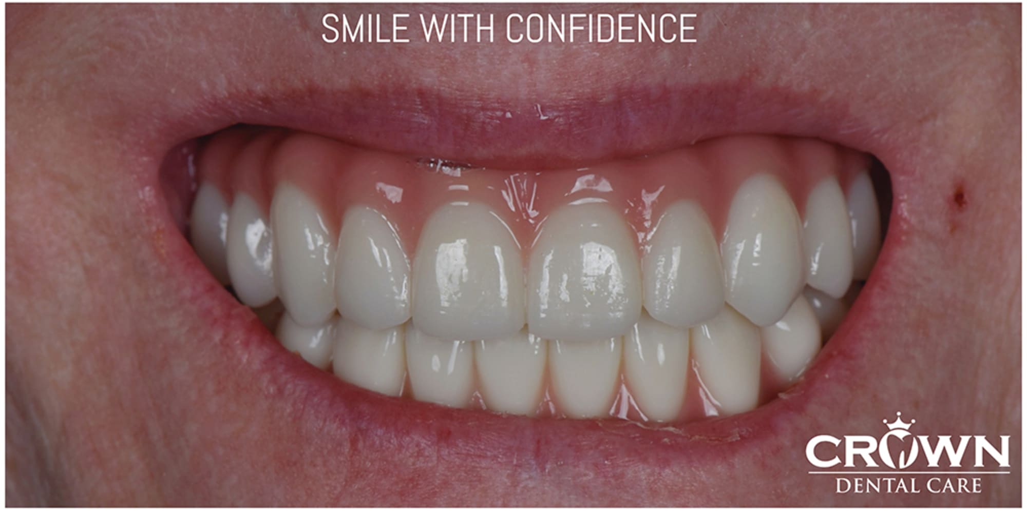 Same patient after implant-supported restoration — natural-looking results, Rockville MD