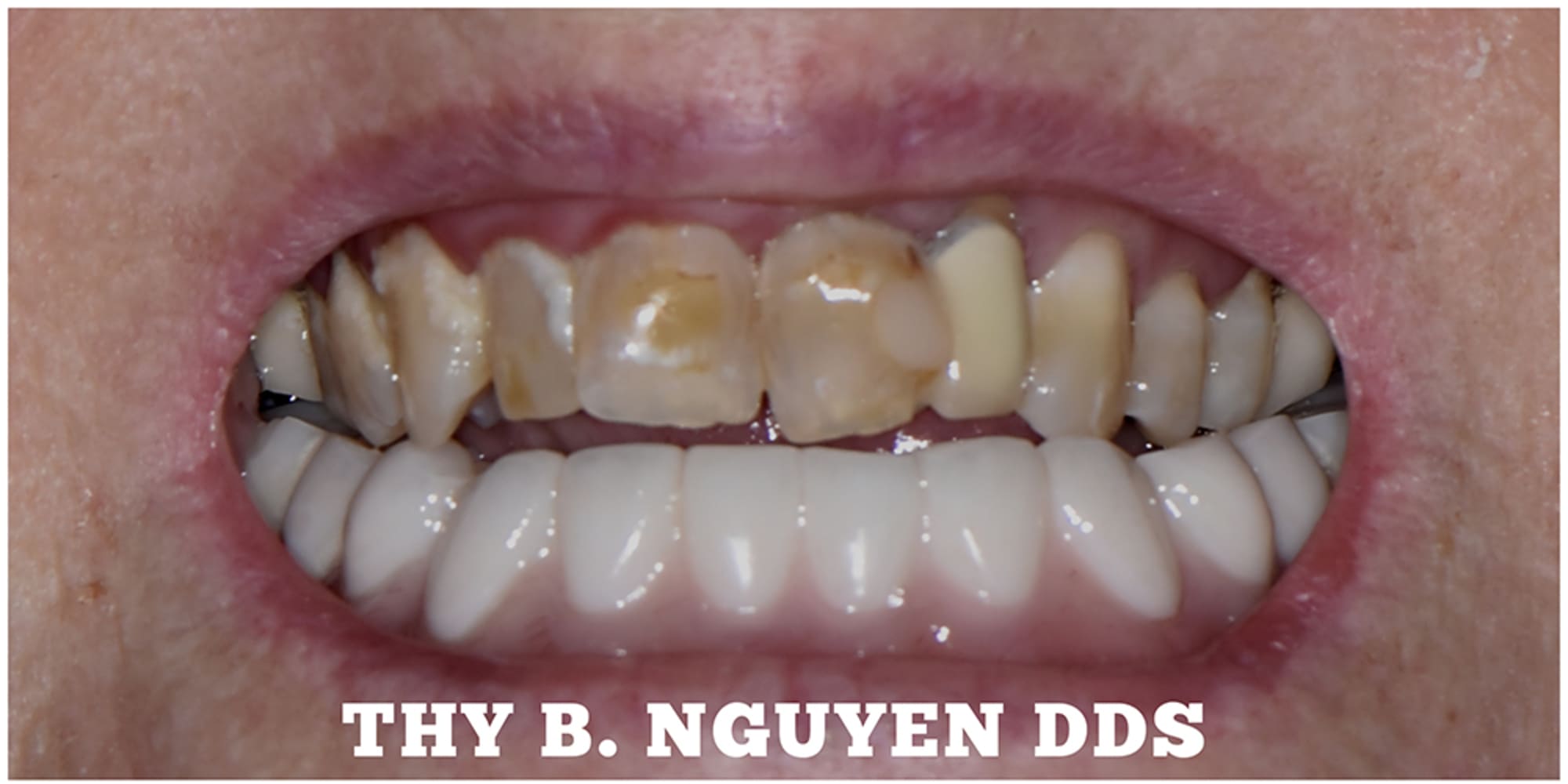 Patient before multi-tooth implant treatment at Crown Dental Care in Rockville, MD