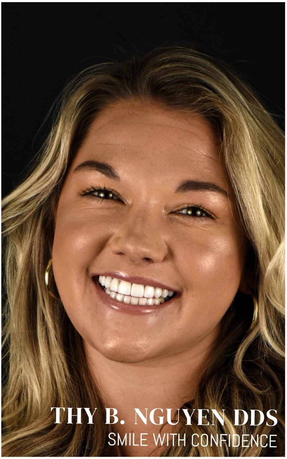 Same patient after porcelain veneers — bright, even smile by Crown Dental Care, Rockville MD