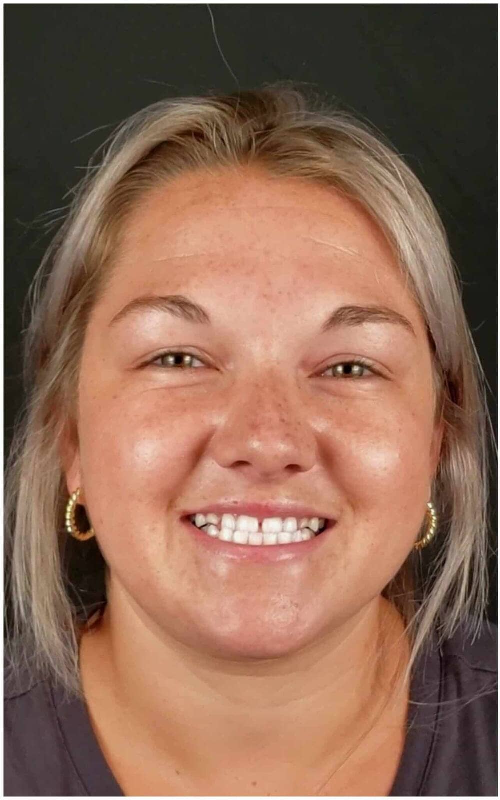 Patient before porcelain veneers — chipped front teeth, Crown Dental Care Rockville