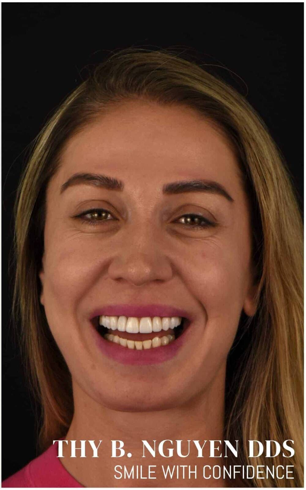 Same patient after porcelain veneers smile makeover at Crown Dental Care