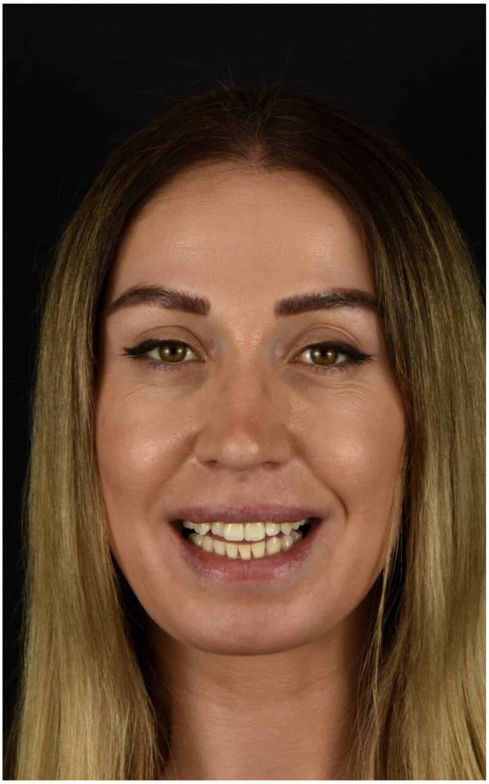 Patient before cosmetic veneers — discoloration and gaps, Rockville MD