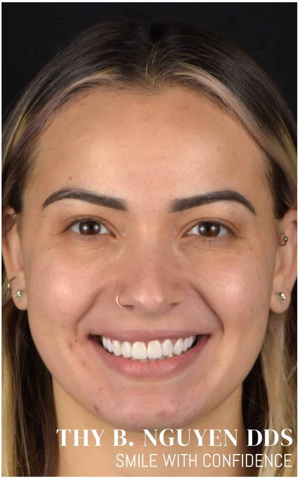 Same patient after custom porcelain veneers — natural, symmetrical smile, Rockville MD