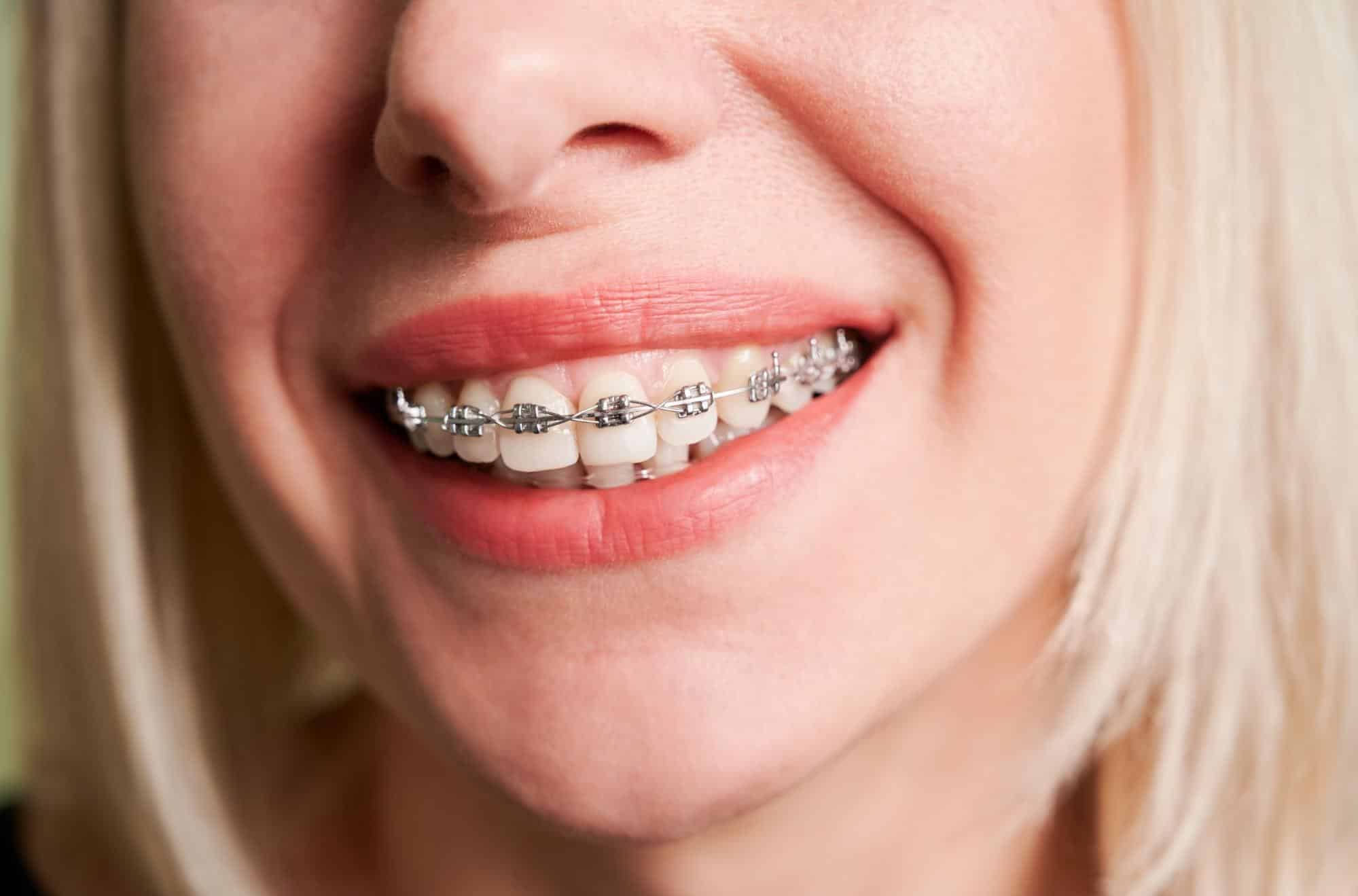 Close-up of an adult woman smiling with traditional metal braces.