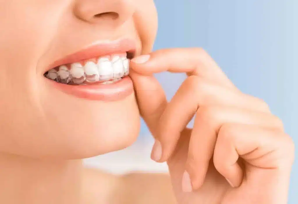 A person placing a clear plastic aligner over their teeth.