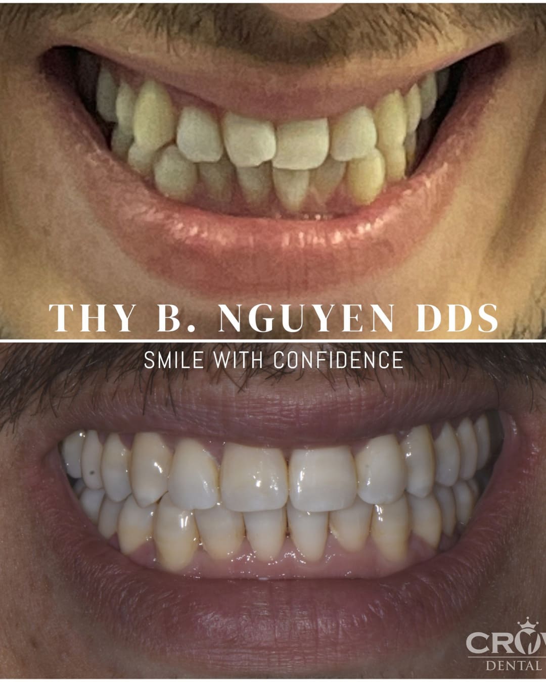 Before and after comparison of a smile transformation by Dr. Thy B. Nguyen at Crown Dental.