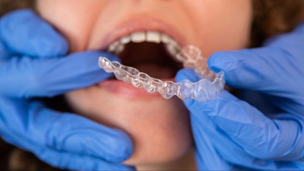 An orthodontic specialist wearing blue gloves fitting a clear aligner for a patient.