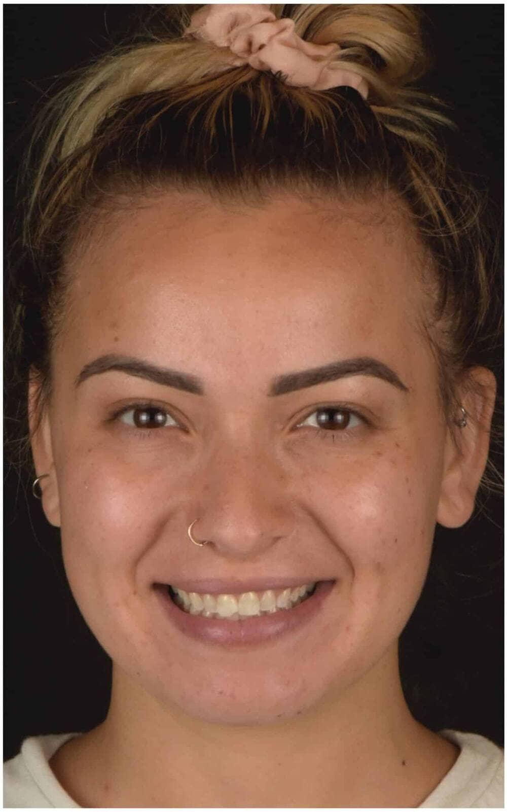 Patient before veneers — worn and uneven teeth, Crown Dental Care Rockville