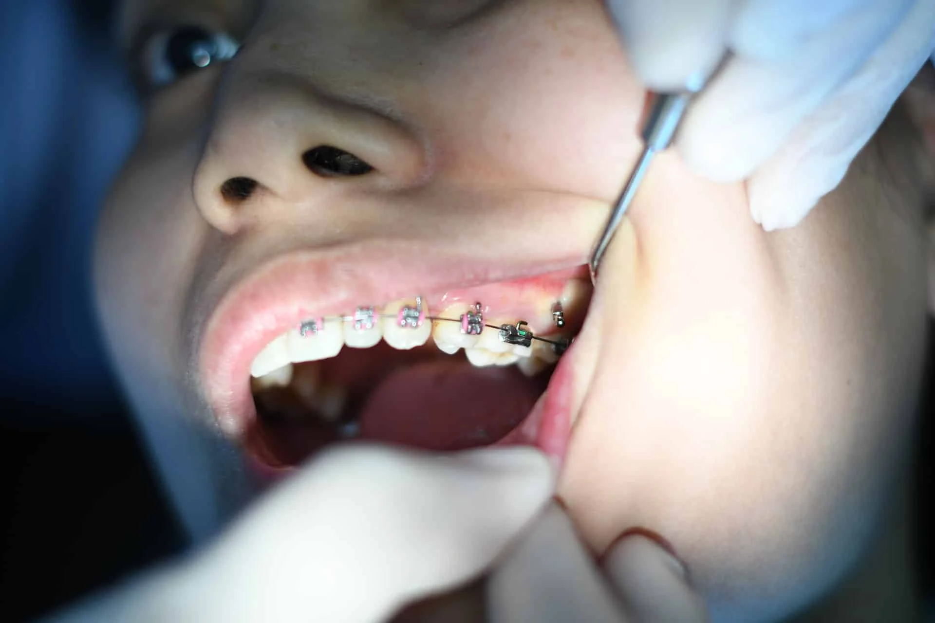 braces and dental implants coexist