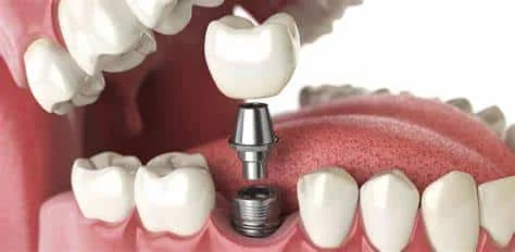 Dental Implants in Chevy Chase MD: Ultimate Guide to Pricing & Value