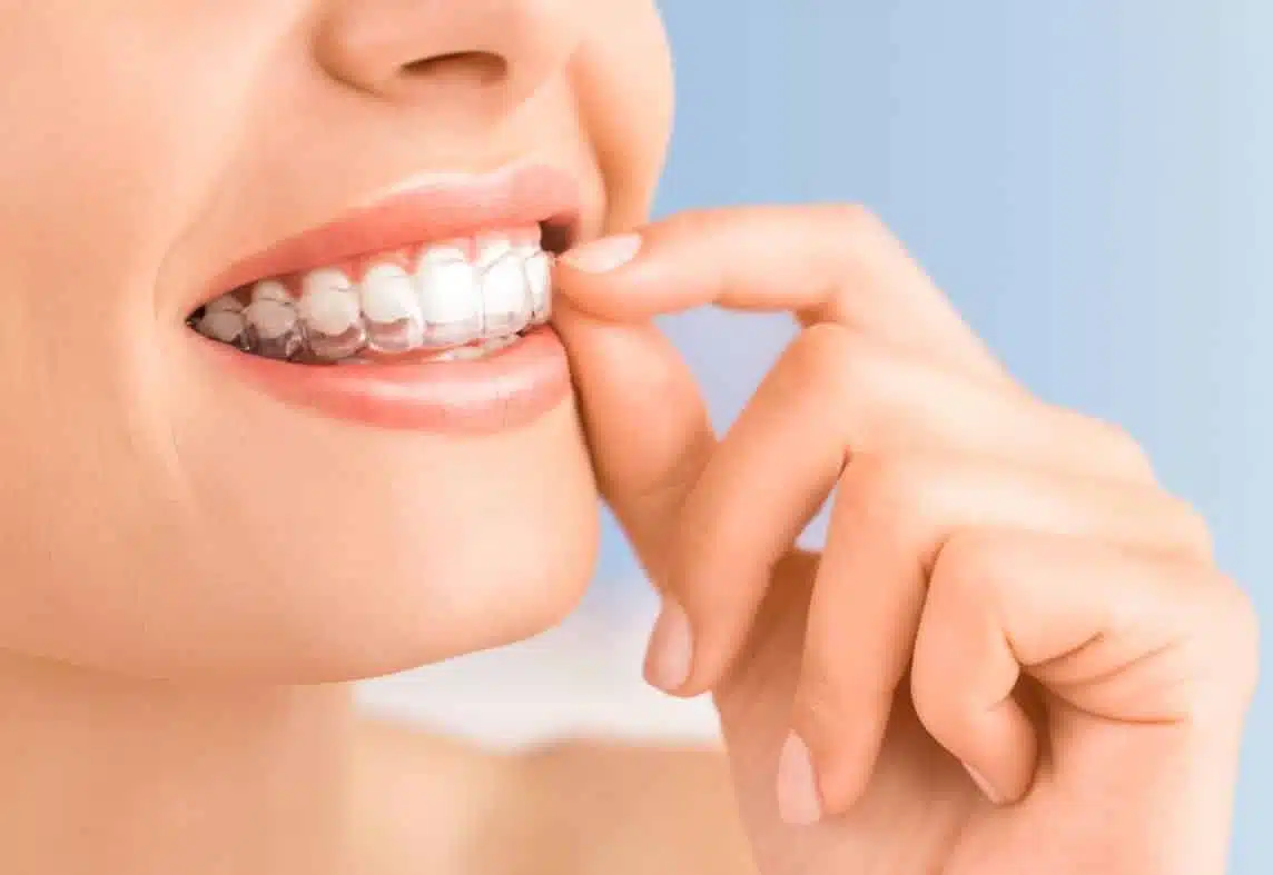 A person placing a clear plastic aligner over their teeth.
